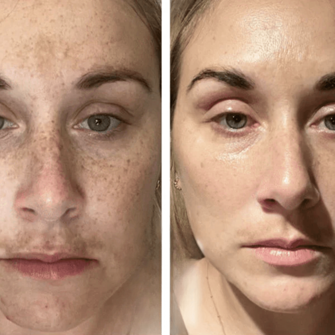 FerméLuxe Peel-Off Face Mask | Removes Sunspots & Pigmentation in Just 7 Days!