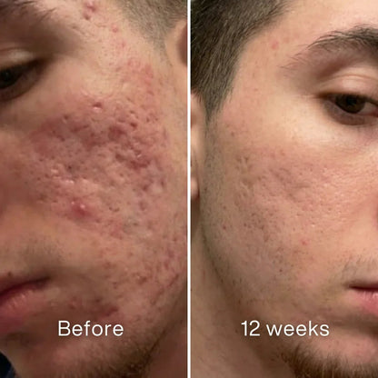 Cheapsu™ Clinical Acne Scar Remodeling Stick