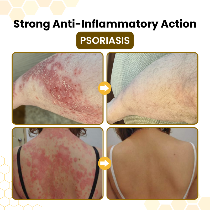 PsoriaSoothe Skin Care Cream